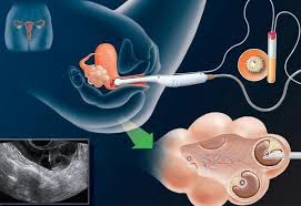 In-Vitro Fertilization Devices Market