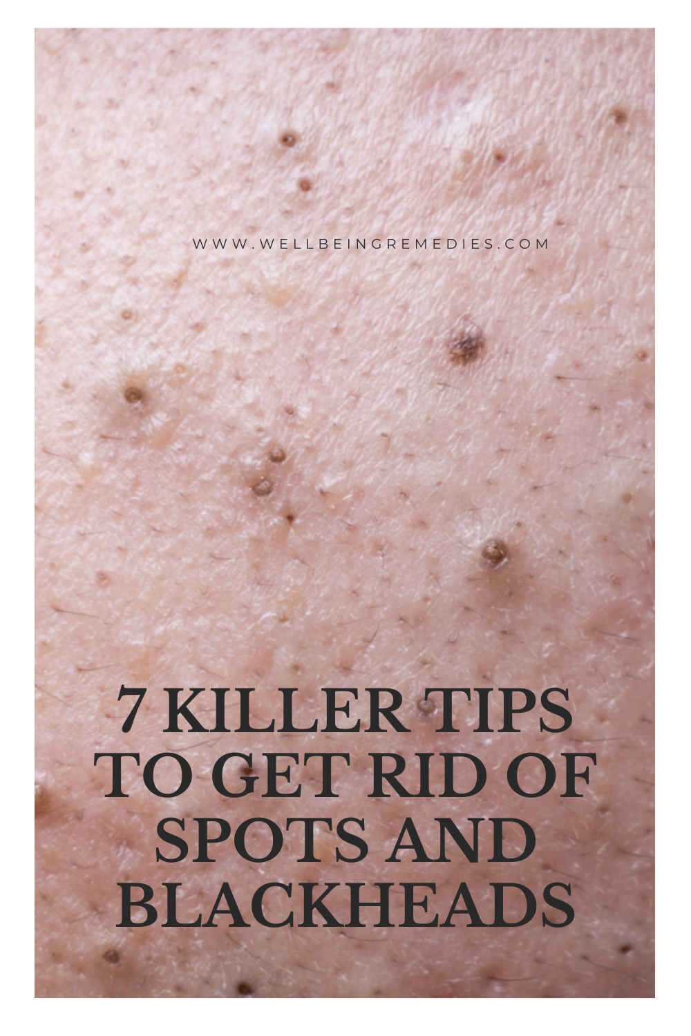 7 Killer Tips to Get Rid of Spots and Blackheads