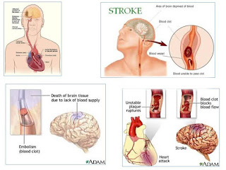 3 Obat stroke herbal yang wajib dicoba