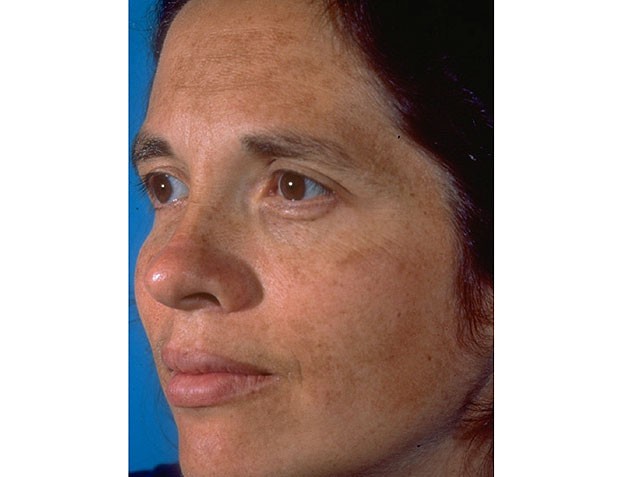 Pigmentation on Face: Home Remedies & Treatment Options