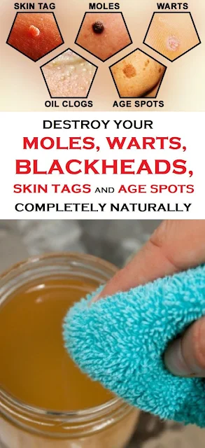 Destroy Your Moles, Warts, Blackheads, Skin Tags And Age Spots Completely Naturally