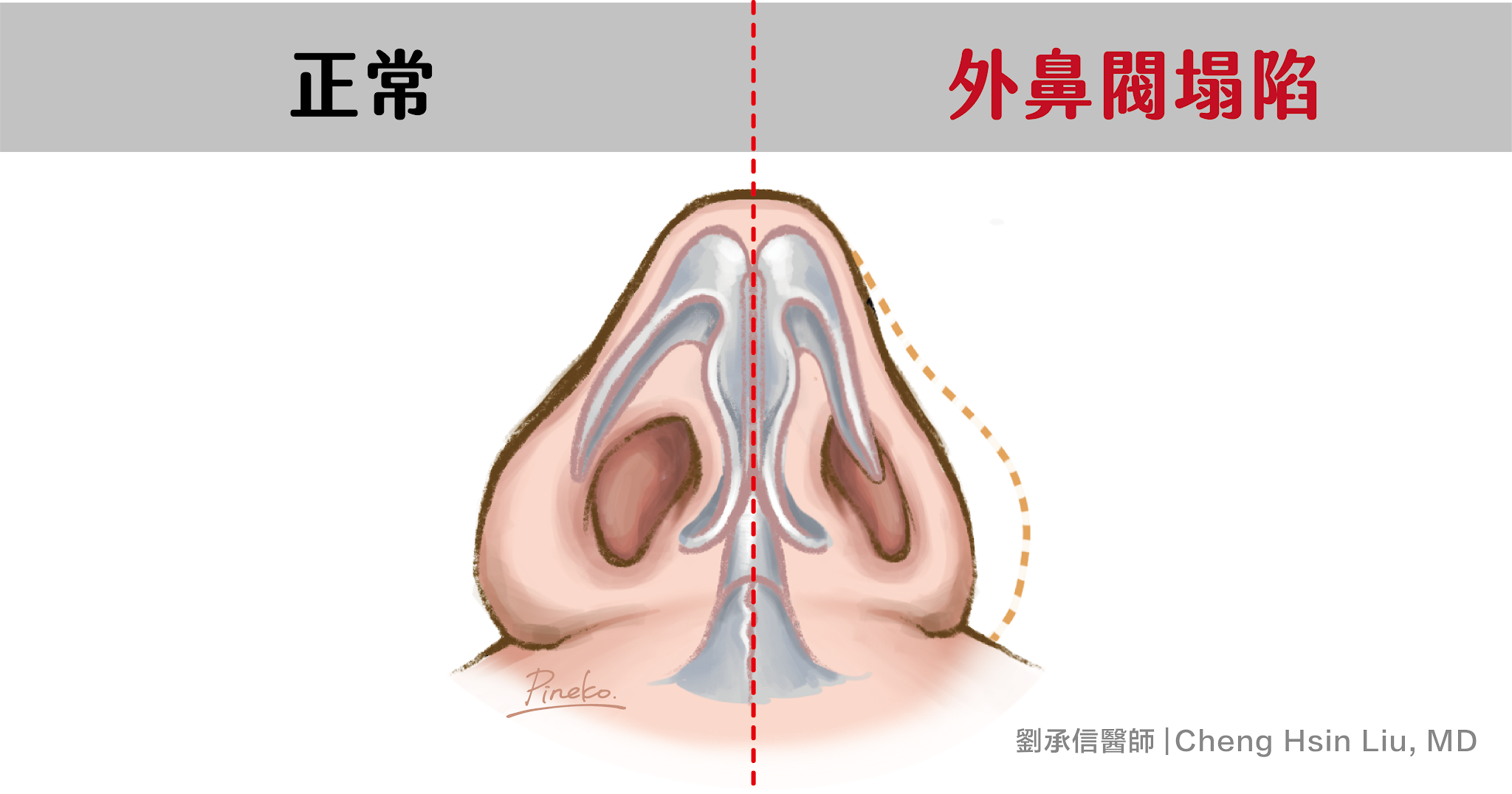 而不管外或內鼻閥塌陷的，可能在呼吸的時候（特別是吸氣）造成，這稱作動態性的塌陷(Dynamic collapse)；有些更嚴重的狀況，在靜態無呼吸的時候就已經出現塌陷(Static collapse)，這在外觀通常也會造成影響。