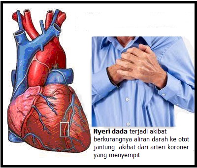 Info Kesehatan Penyakit Jantung  Koroner 