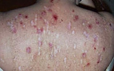 Morgellons Disease Pictures5