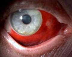 bulimia subconjunctival hemorrhage eye purging