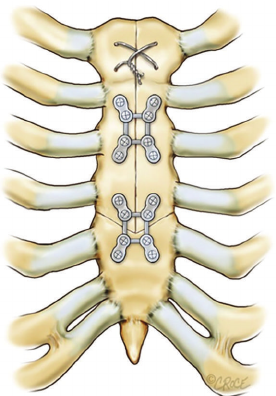 Rigid Sternal Fixation