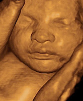 3d Ultrasound6