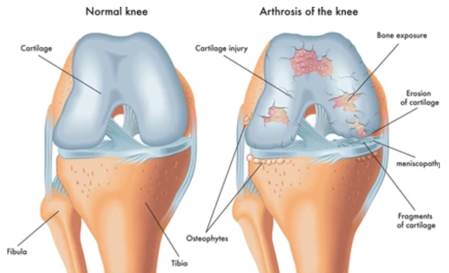 Managing Knee Arthritis Without Surgery A Comprehensive Guide