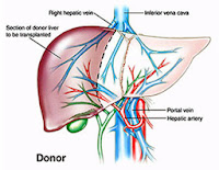  India Surgery Kidney Transplant