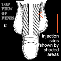 injection-in-penis-for-erection-7