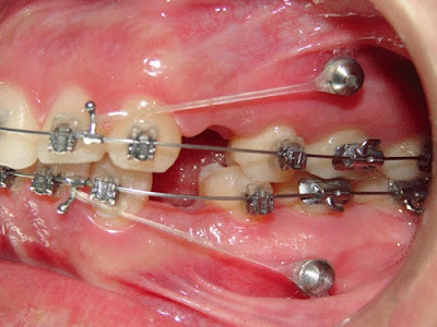 Nhổ 4 răng để niềng răng có ảnh hưởng tới chức năng về sau?-1