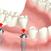 Gigi Implan Solusi Untuk Gigi Tanggal