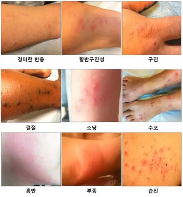 빈대에 물린 후 다양한 피부 반응