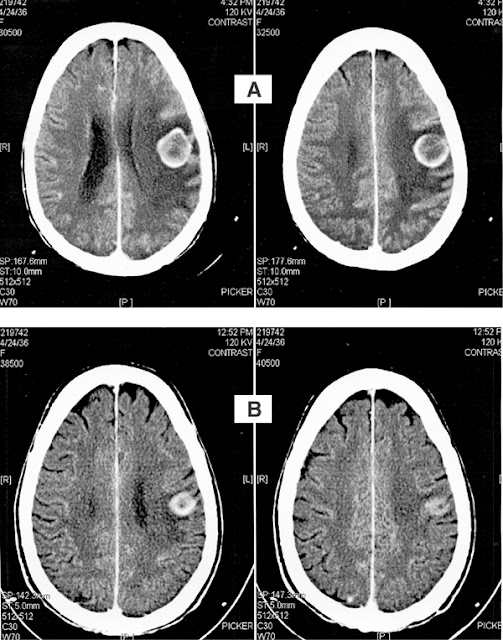 Brain Ct Scan2