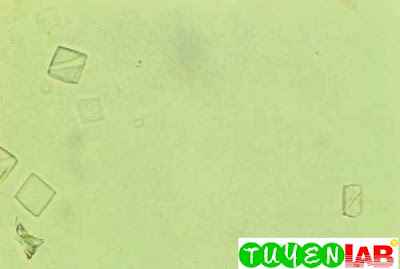 Uric acid crystals, diamond or rhombic form.  These crystals are very thin and almost colorless (400x)