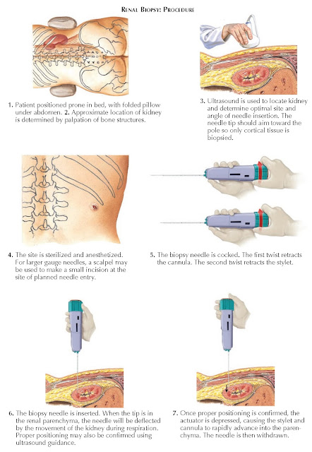 RENAL BIOPSY: PROCEDURE