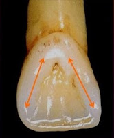 landmarks of the teeth | Elevated landmarks & Depresses landmarks.