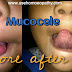 Mucocele Homeopathic Treatment