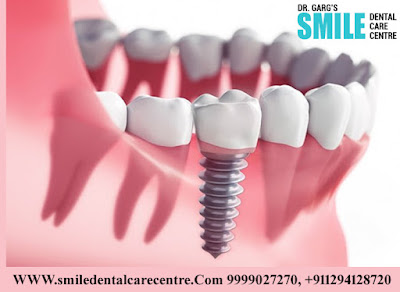 Best Dental Implant Clinic in Faridabad