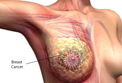 WHAT IS BREAST CANCER? WHAT ARE FIVE WARNING SIGNS OF BREAST CANCER? CAN BREAST CANCER KILL YOU? IS BREAST CANCER DANGEROUS FOR LIFE? WHAT PART OF THE BREAST CANCER USUALLY FOUND? CAUSES, SYMPTOMS, DIAGMOSIS, TREATMENT