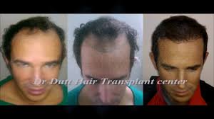 http://www.drdutthairtransplant.com/hair-transplant-in-south-delhi/