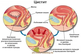 цистит