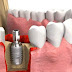 Giá trồng răng implant bao nhiêu hiện nay?
