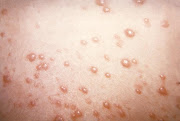 herpes simplex (HSV2)