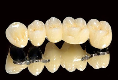 Cầu răng sứ titan là gì?