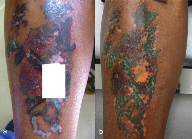 Color Tattoo On Dark Skin Laser tattoo removal in dark