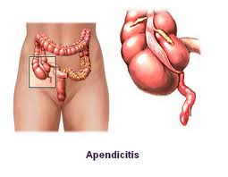 NANDA Appendicitis