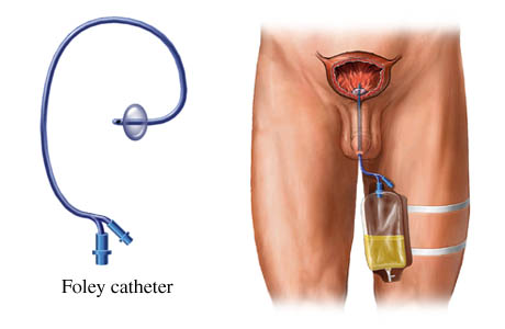 Bag Catheter7