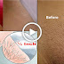 If You Want To Remove Pubic Hair Permanently Then Try This Simple Home Method