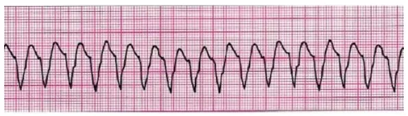 Adolescente, após tentativa de suicídio com ingestão de antidepressivo tricíclico, manifestou parada cardiorrespiratória. Durante a reanimação cardiopulmonar, observou-se o seguinte ritmo no monitor cardíaco.