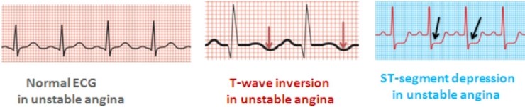 心絞痛 Angina