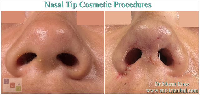 Nostril Reducing,Tip Plasty,Nose Tip Lifting,Droopy Tip Correction,Nosal Tip Surgery in İstanbul,Alar Plasty,Alar Base Resection,