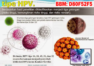 Obat Kutil Kelamin, Cara Mengobati Kutil Dikemaluan Kelamin Dari Rumah Sendiri, Dokter Obat Kutil Kelamin Terbukti Terbaik Dan Terpercaya