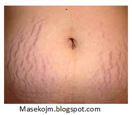 Cara Mudah Menghilangkan Stretch Marks atau Selulit