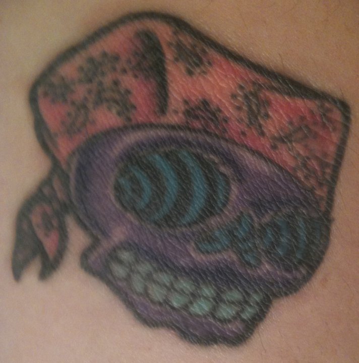 Trichloroacetic Acid (TCA) Tattoo Removal: June 2011