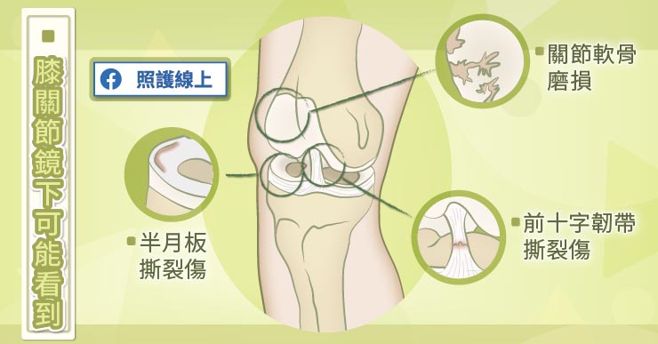 膝蓋痛 膝關節鏡有幫助嗎 懶人包 照護線上