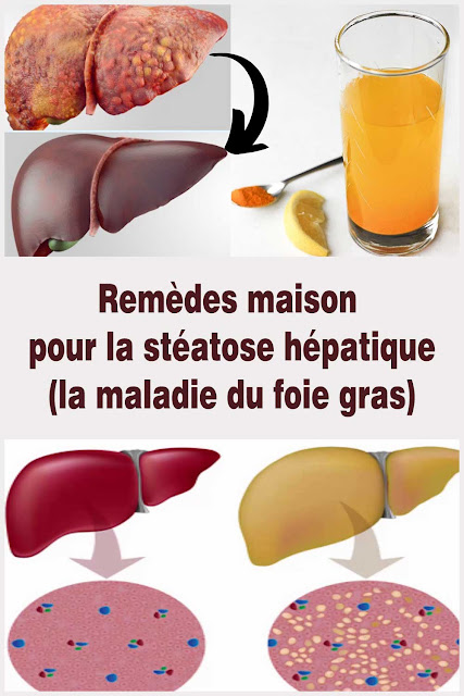 Remèdes maison pour la stéatose hépatique (la maladie du foie gras)