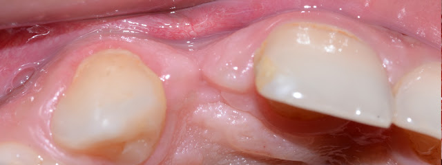 Deficient Bone Width after Removal of Fractured Root of Lateral Incisor