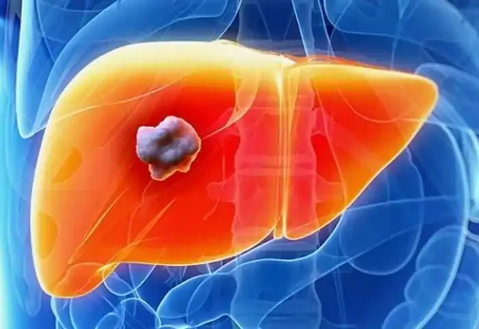 Cancer, Lifestyle, Malayalam News, Health Tips, Liver Cancer, Health News, Health, Signs and Symptoms of Liver Cancer in men.