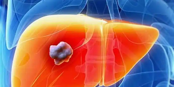 Liver Cancer | ഈ 5 ലക്ഷണങ്ങള്‍ പുരുഷന്മാരില്‍ കരള്‍ കാന്‍സറിന്റെ ലക്ഷണമാകാം; അശ്രദ്ധ കാണിക്കരുത്
