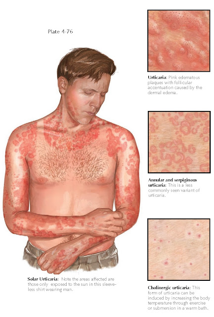 URTICARIA