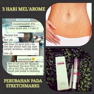 Cara Mencegah Dan Mengatasi Stretch Mark Saat Hamil