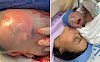 Bebê nasce empelicado em hospital de Goiás