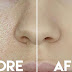 How to Close Open Pores Permanently At Home