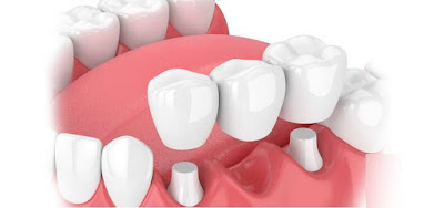 Quy trình trồng răng khi còn chân răng