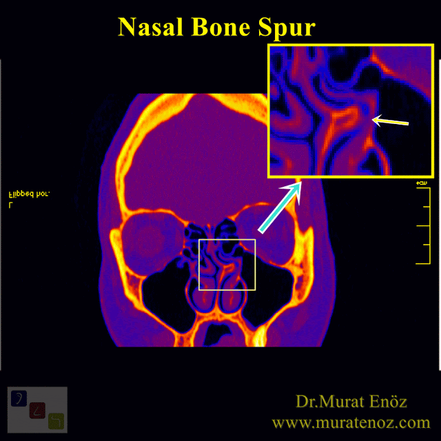 Spur of Nose - Nasal Bone Spur - Bony Nasal Septal Spur - Nasal Bone Spurs Surgery - Nasal Bone Spurs Surgery İstanbul - Nasal Bone Spur Treatment in Turkey - Symptoms - Contact Point Headaches - Diagnosis of Nasal Bone Spur - Removal of a Septal Bone Spur - Atypical Headache